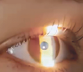 PureVision™ | Vision-Enhancing Roller