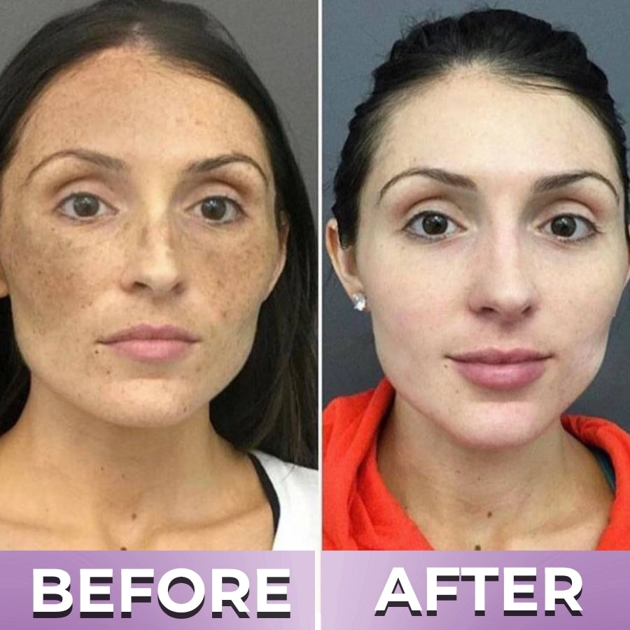 BrillaSkin™ | Advanced Anti-Hyperpigmentation Cream