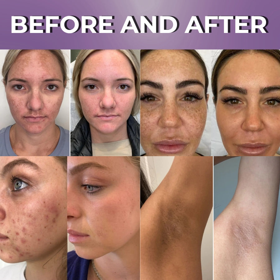 BrillaSkin™ | Advanced Anti-Hyperpigmentation Cream