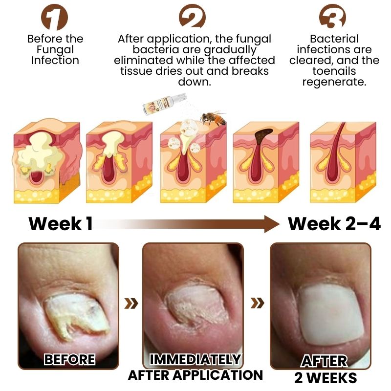 FungaBee® | Bee Venom Nail Care Spray