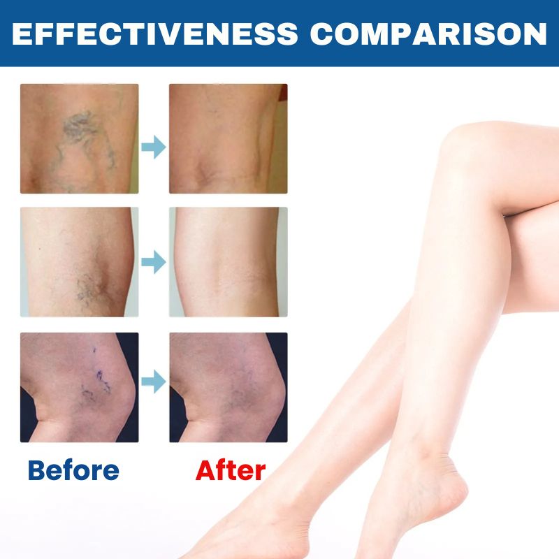 VenoAid™ | Varicose Vein Solution Spray