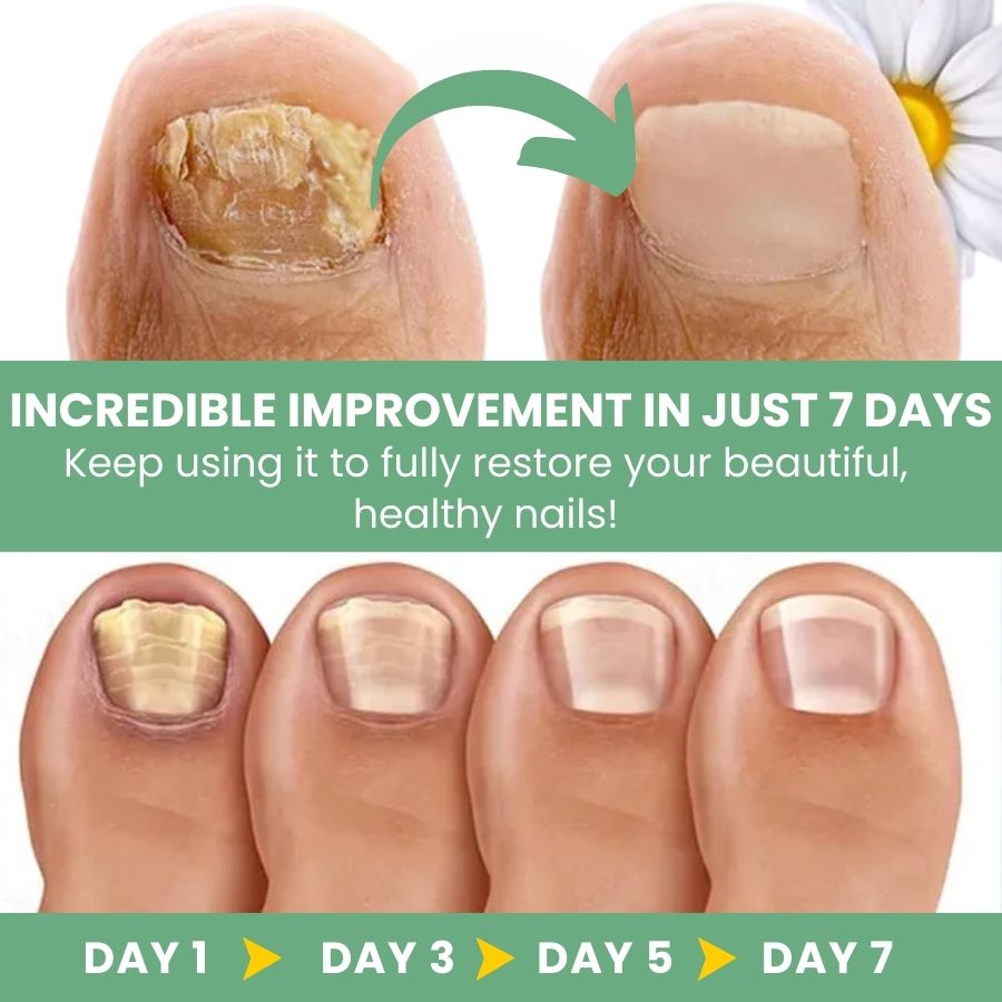 FungBoost™ | Nail Fungus Treatment Gel
