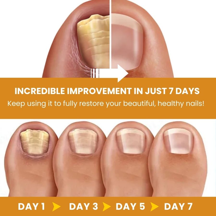 FungiHeal™ | Nail Fungus Treatment Spray