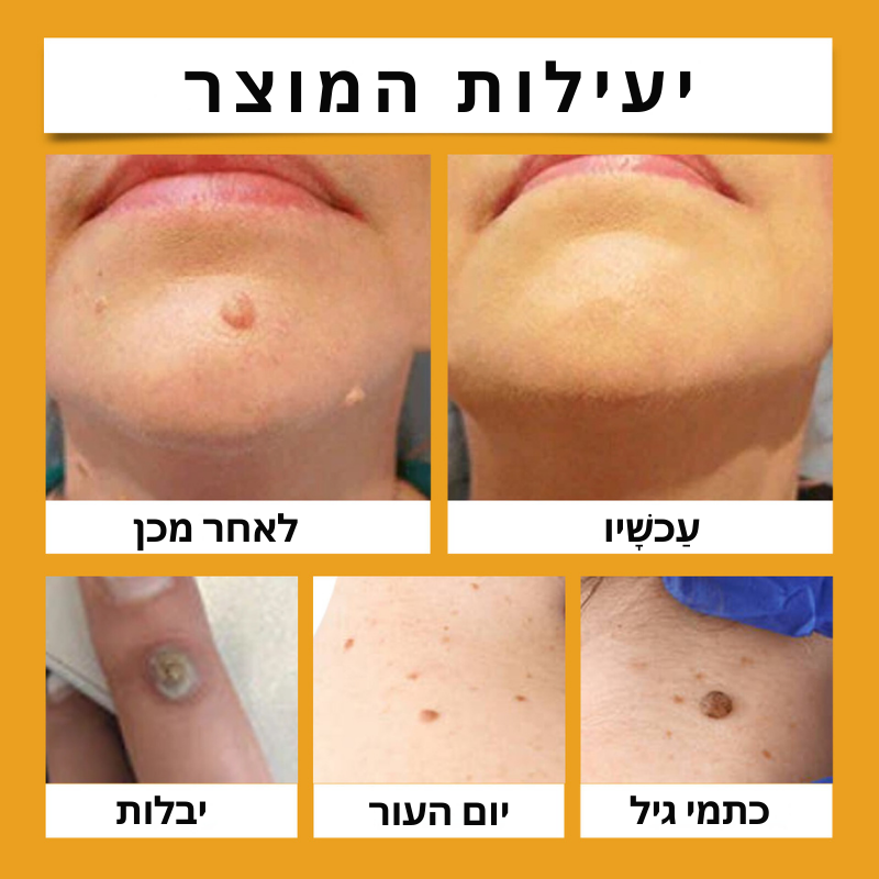 HautKlar™ | היפטר מיבלות עור מעצבנות תוך 7 ימים בלבד!