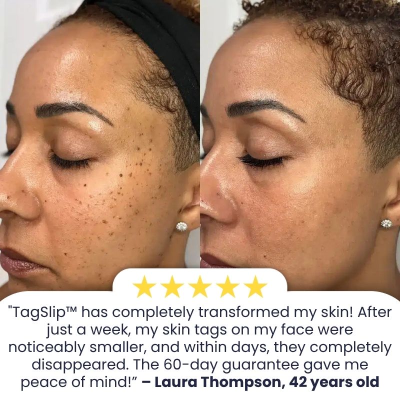 TagSlip™ | Painless Skin Tag Remover