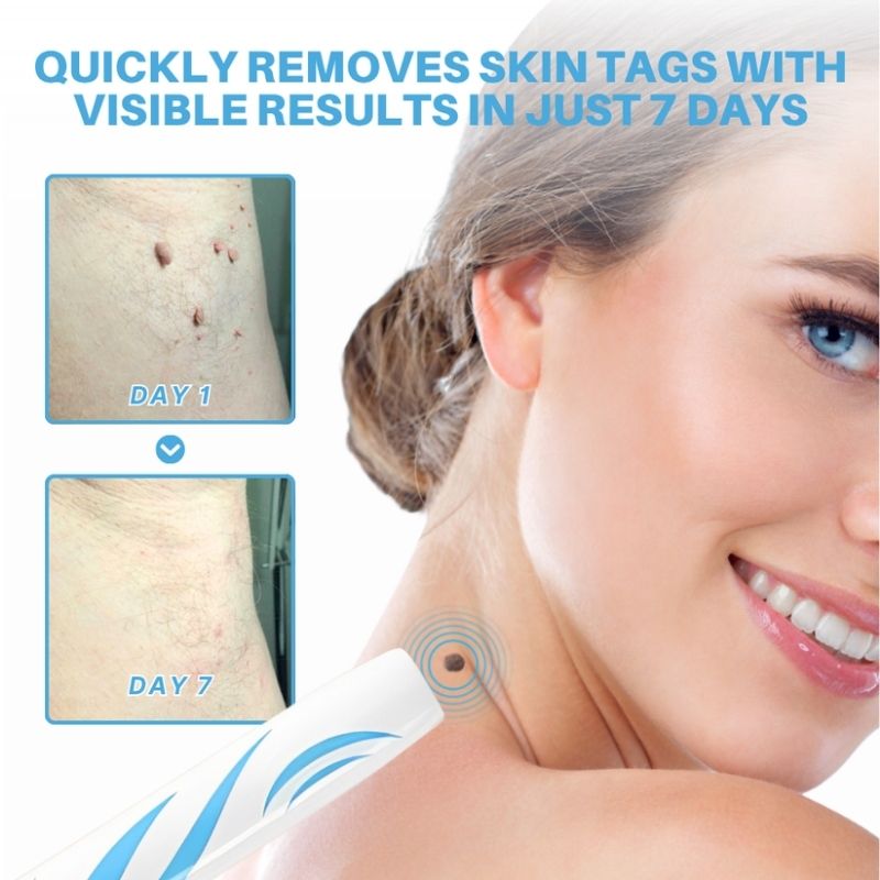 TagSlip™ | Painless Skin Tag Remover