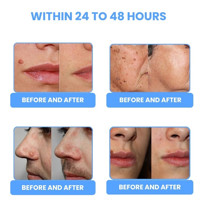 LaserPen™ | Plasma Skin Corrector Pen