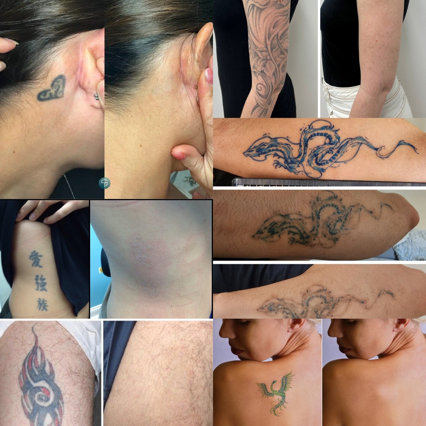 TattGone™ Spray Bottle | 99% Tattoo Ink Removed!