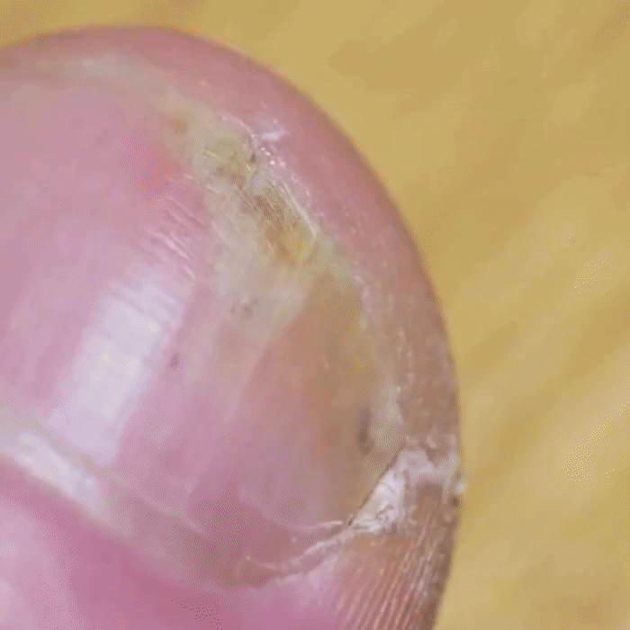 NailVive™ | Toenil Fungus Pen