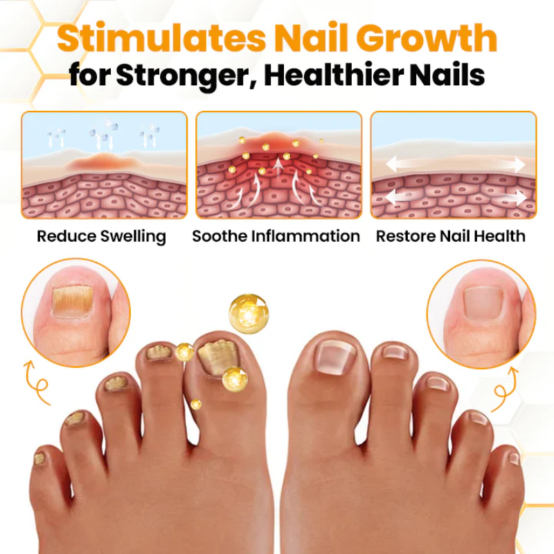 NailRenew™ | Antifungal Nail Renewal Oil