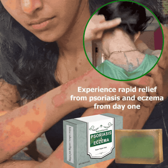 CrocDerma™ | Crocodile Oil Soap for Psoriasis and Eczema