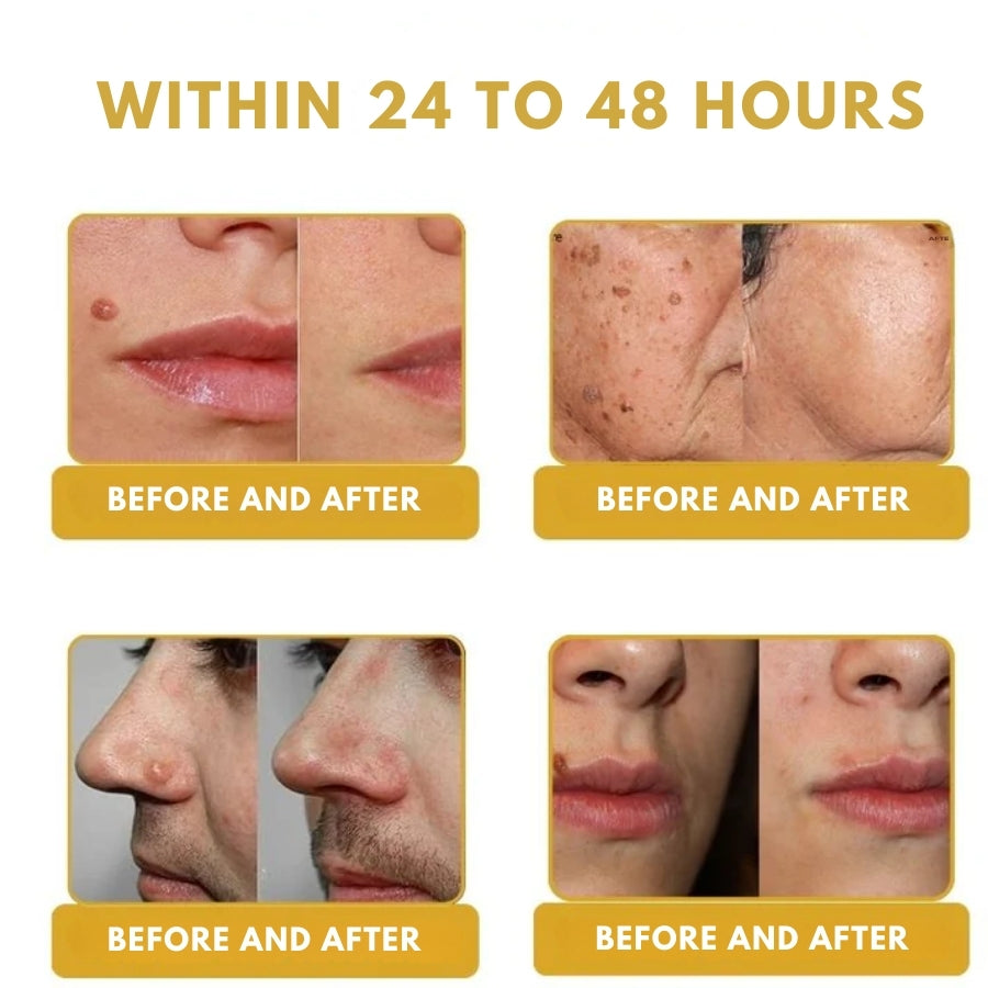 ClearZap™ | Bee Venom Wart Remover