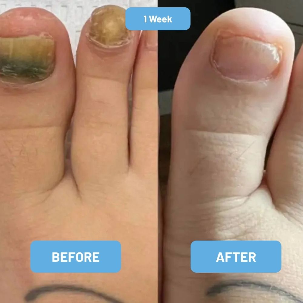 FungiCure™ | Nail Treatment Gel