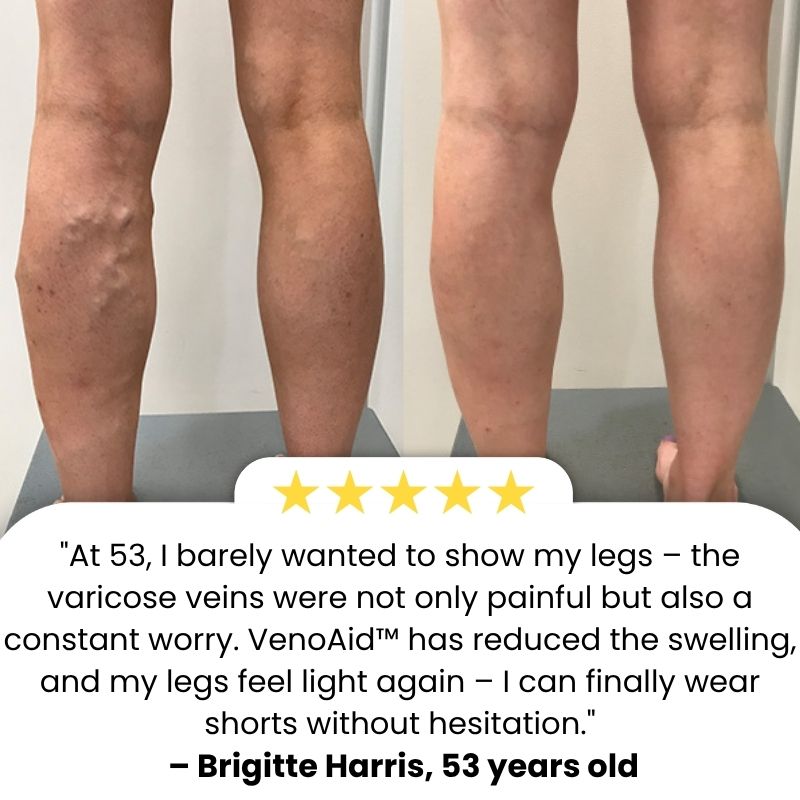 VenoAid™ | Varicose Vein Solution Spray