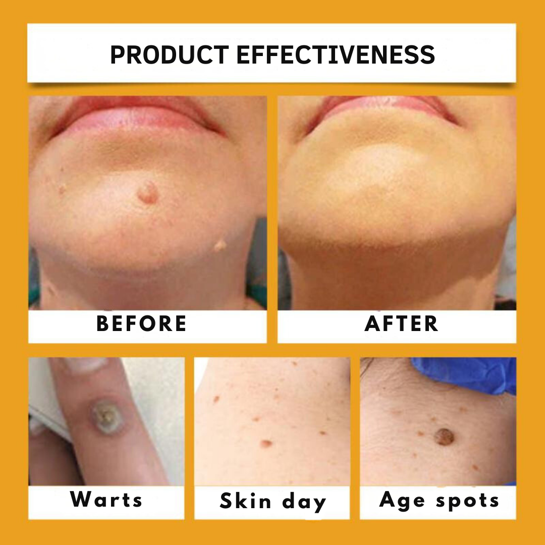 SkinClear™ | Get Rid of Annoying Skin Warts in Just 7 Days!