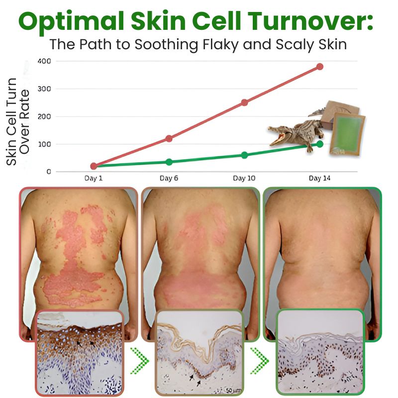 CrocDerma™ | Crocodile Oil Soap for Psoriasis and Eczema