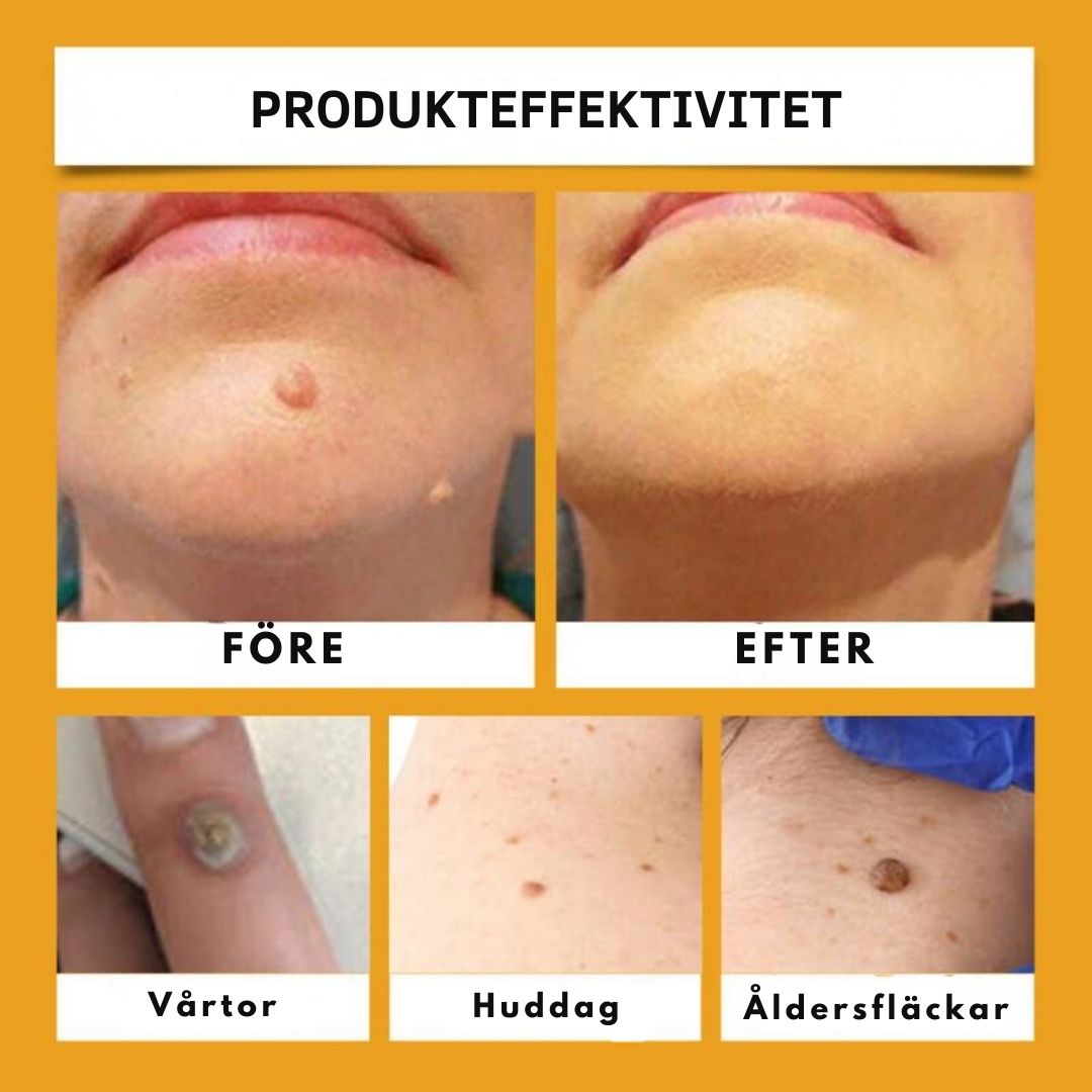 HudKlar™ | Bli av med irriterande hudvårtor på bara 7 Dagar!