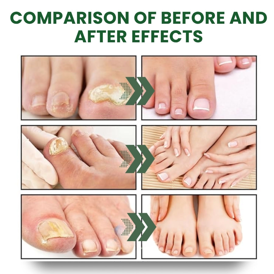 NailHeal™ | Herbal Nail Renewal Spray