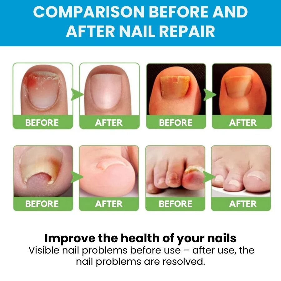ClearNail™ | Fast Antifungal Ointment
