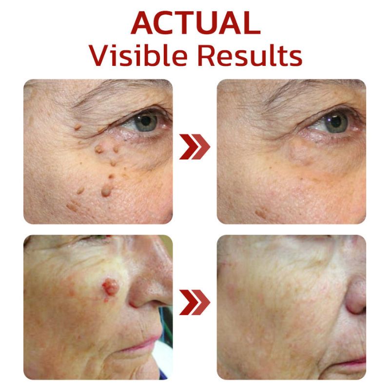 DermaFix™ | Tags & Moles Remover Serum Pen
