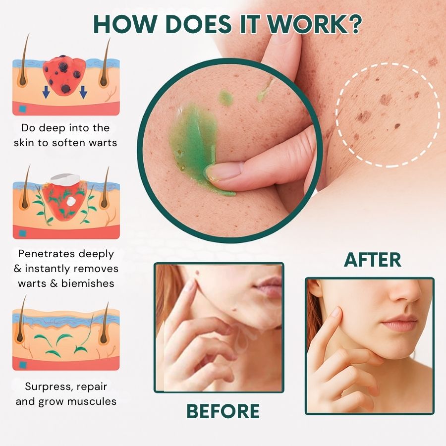 PerfectSkin™ | Instant Mole & Spot Removal Gel