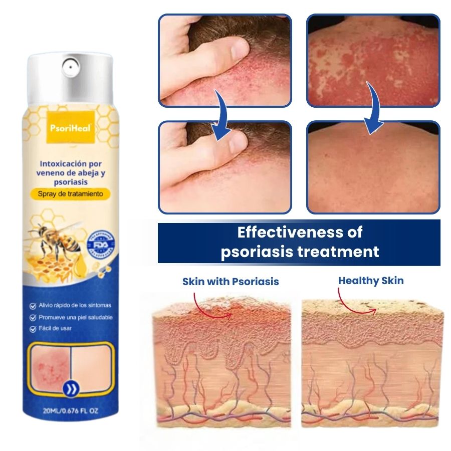 PsoriHeal™ | Psoriasis and Eczema Treatment Spray
