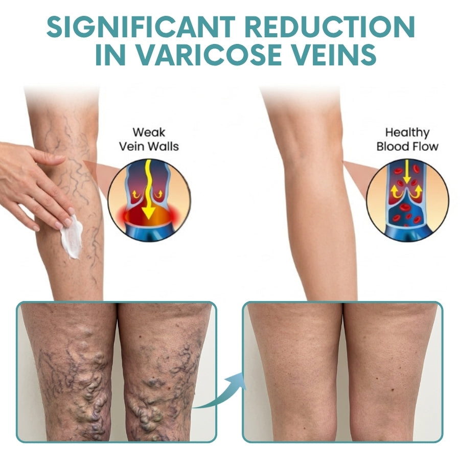 VeinRestore™ | Varicose Vein Cream
