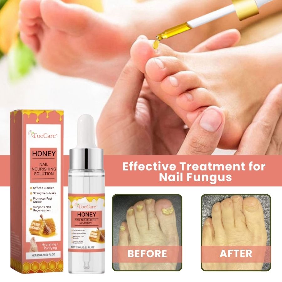 ToeCare™ | Nail Fungal Treatment Drop