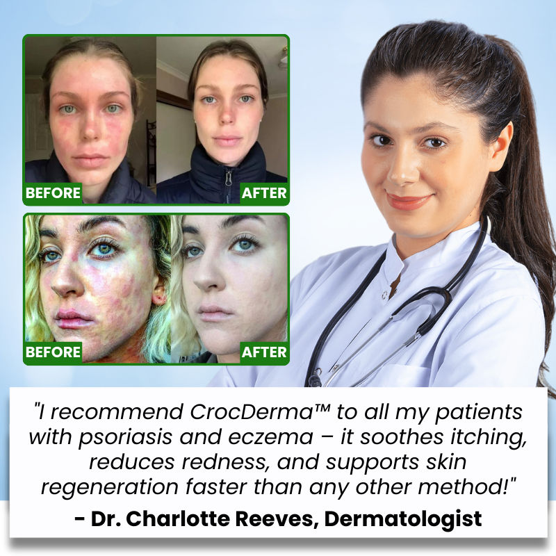 CrocDerma™ | Crocodile Oil Soap for Psoriasis and Eczema