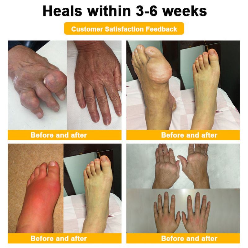 ArthroFlex™ | Botulinum Toxin & Bee Venom for Bone Healing