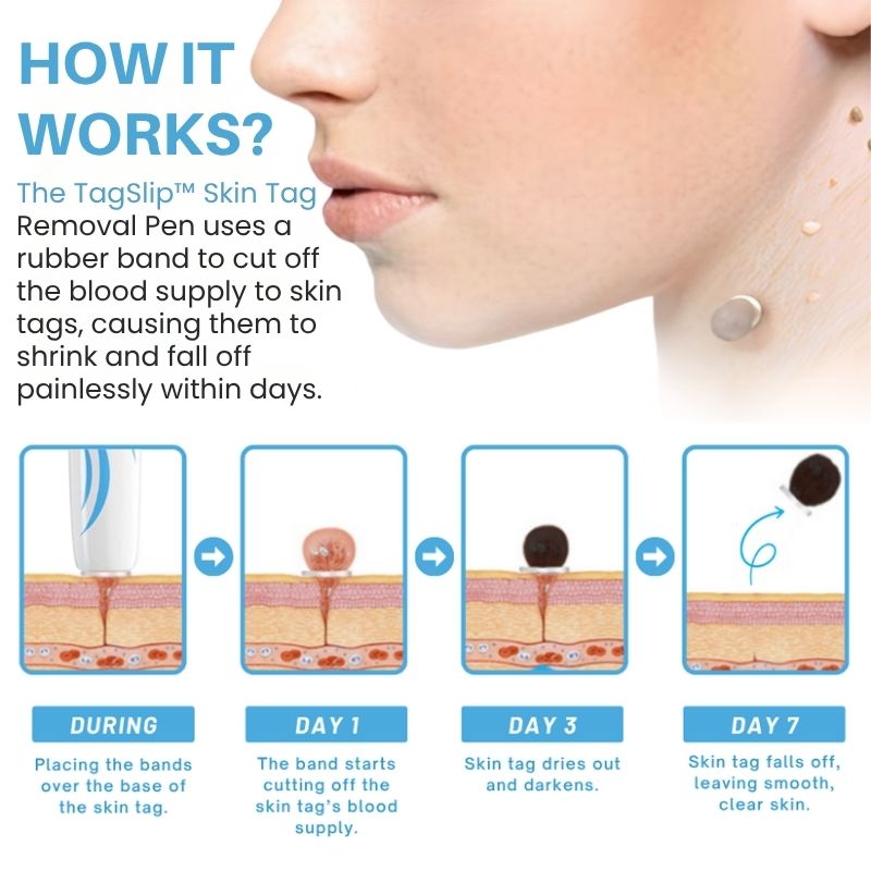 TagSlip™ | Painless Skin Tag Remover