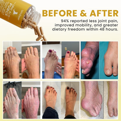 UricEase™ | Daily Uric Acid & Joint Support Capsules