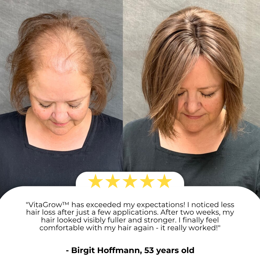 VitaGrow™ Spray | Stop hair loss and Regrow up to 99%!