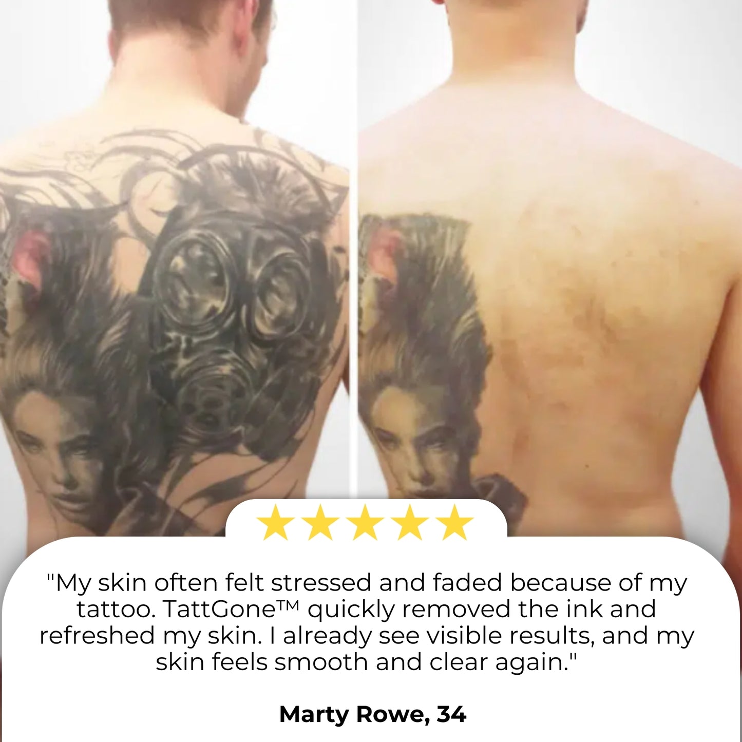 TattGone™ Spray Bottle | 99% Tattoo Ink Removed!