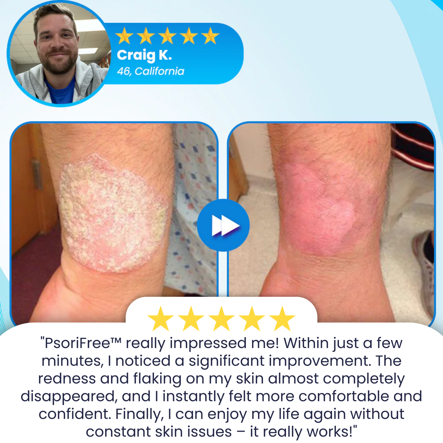 PsoriFree™ | End Redness and Flaking in 5 Days!