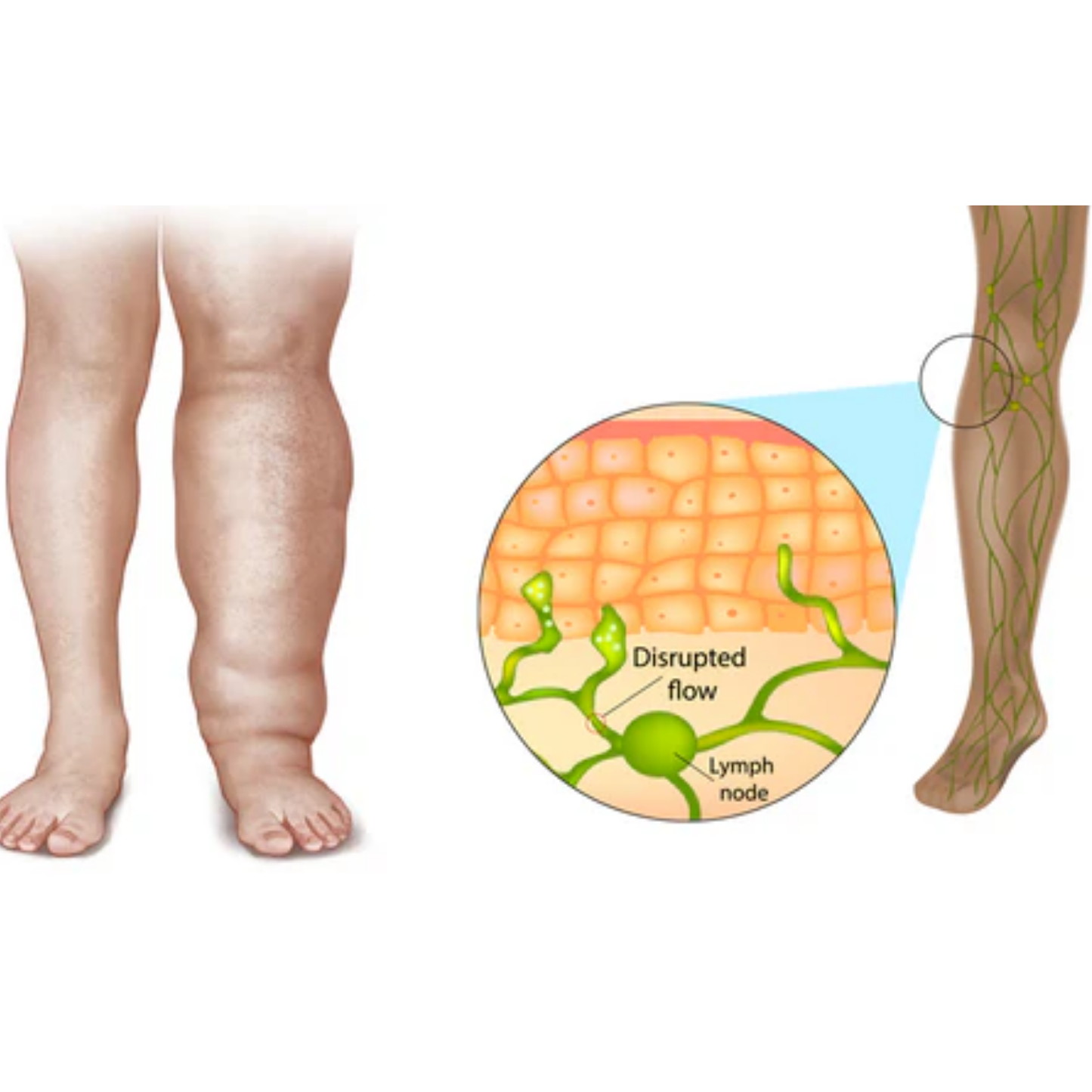 LymphRelief™ | Relieve Swelling in Just 15 Minutes!