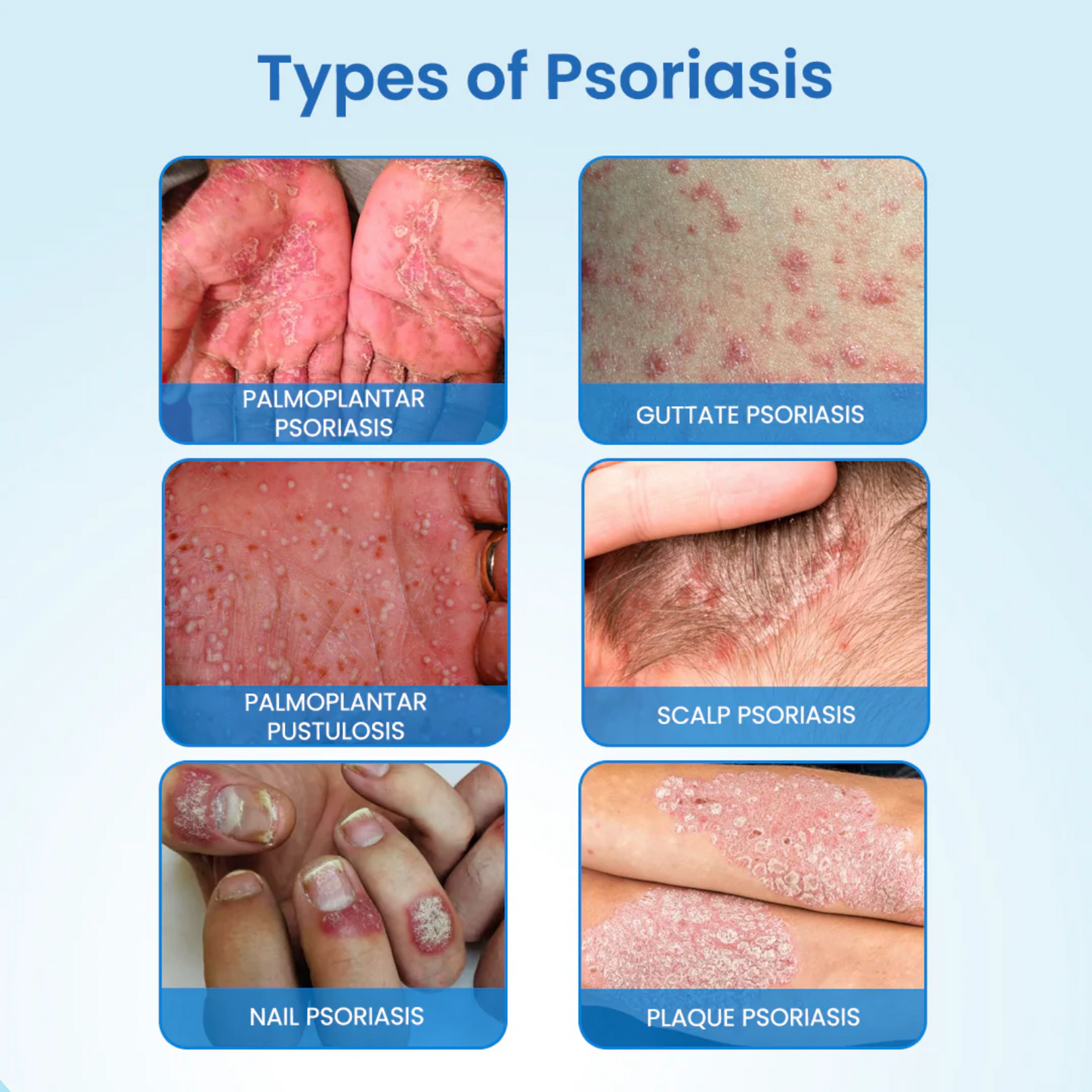 PsoriFree™ | End Redness and Flaking in 5 Days!