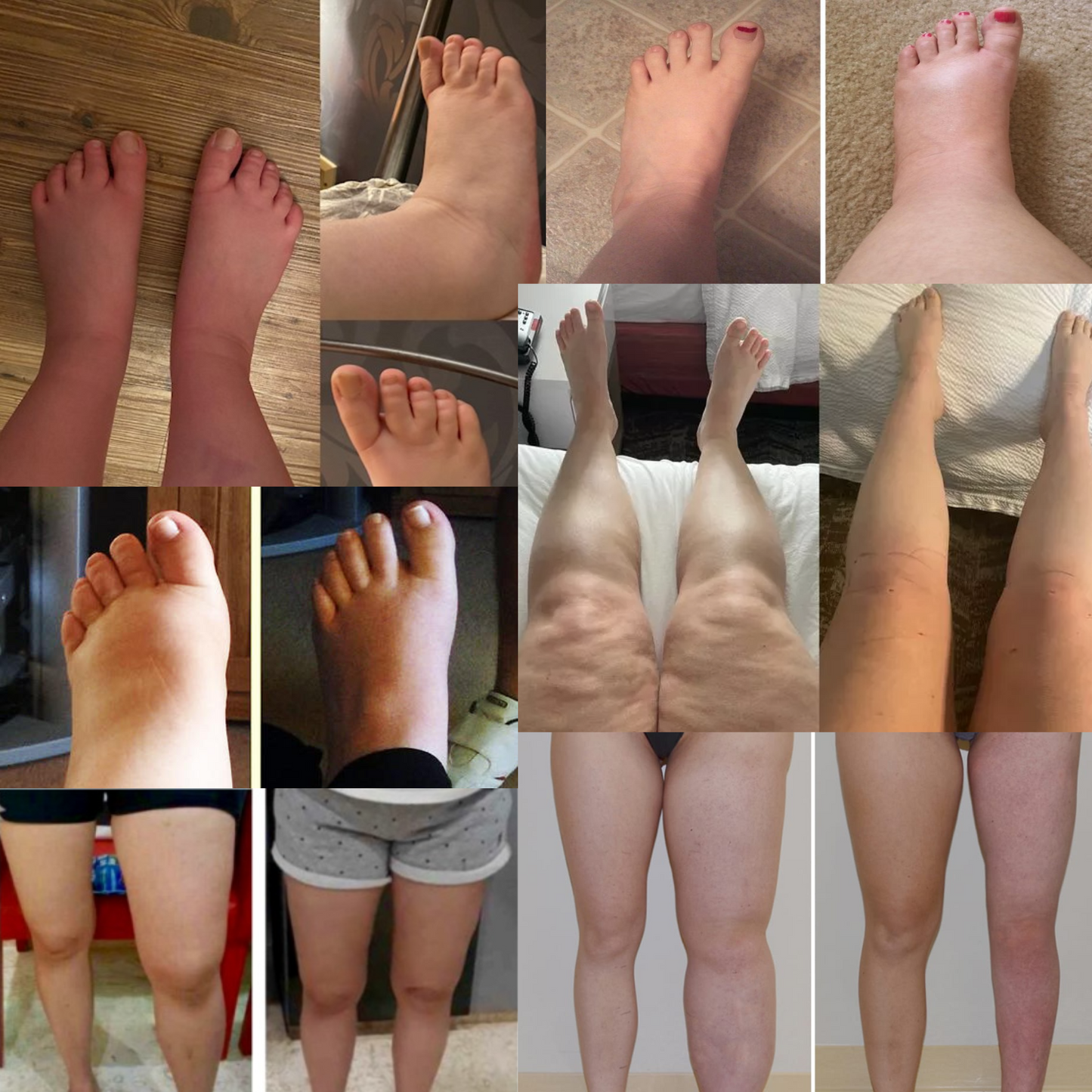 LymphRelief™ | Relieve Swelling in Just 15 Minutes!