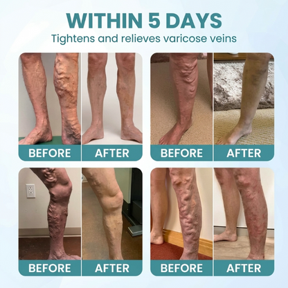 VeinRestore™ | Varicose Vein Cream